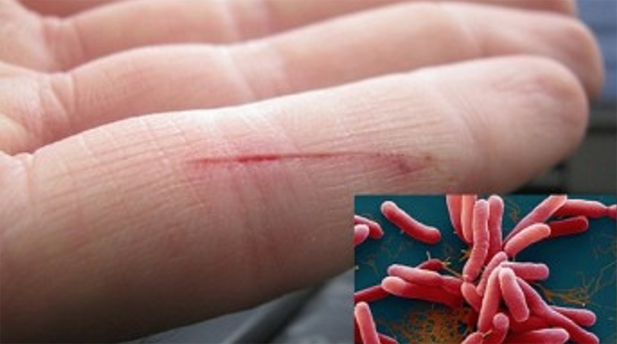 “vi khuẩn ăn thịt người” Whitmore có thể gây nhiễm bệnh từ những vết xước nhở trên bàn tay.