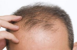 Nguyên nhân gây rụng tóc ở nam giới?